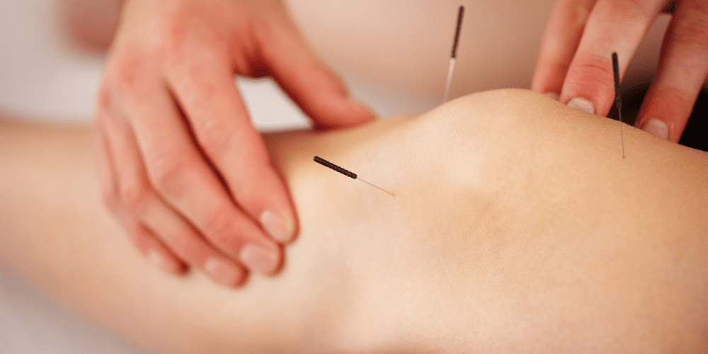 acupuncture douleur musculaire